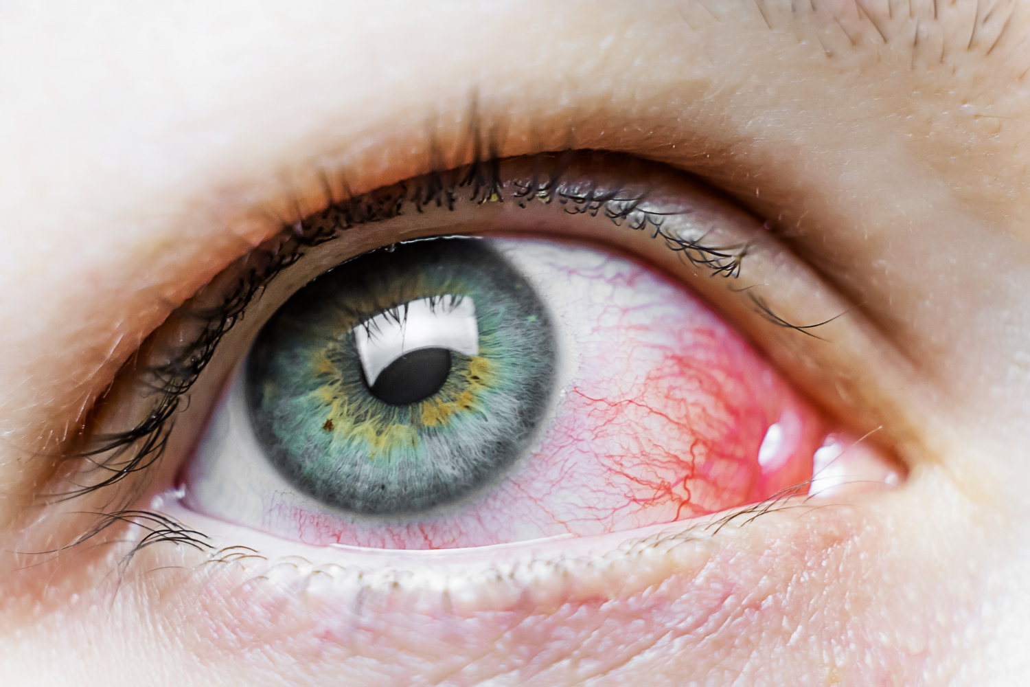 conjuntivitis
