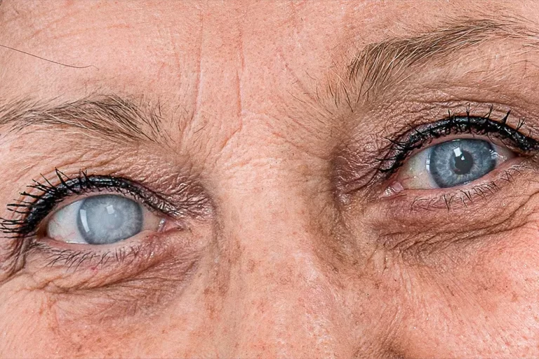 ojo con cataratas