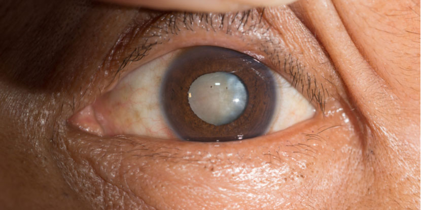 ojo cataratas