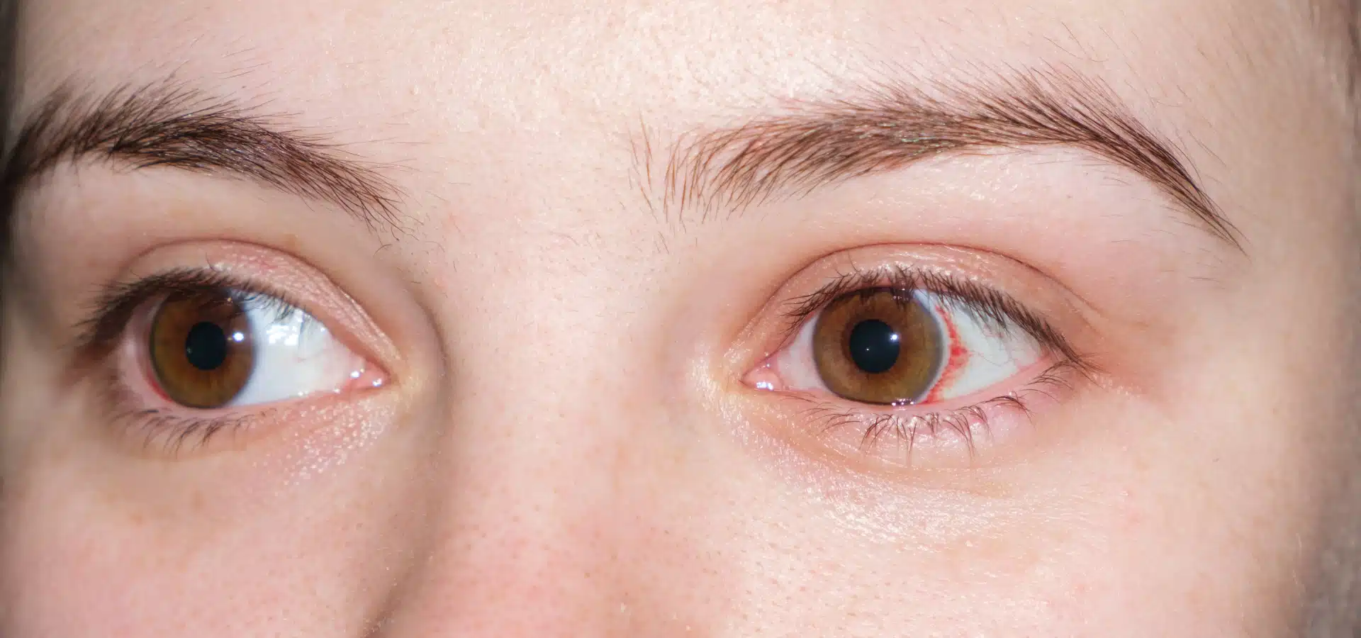 Presión ocular